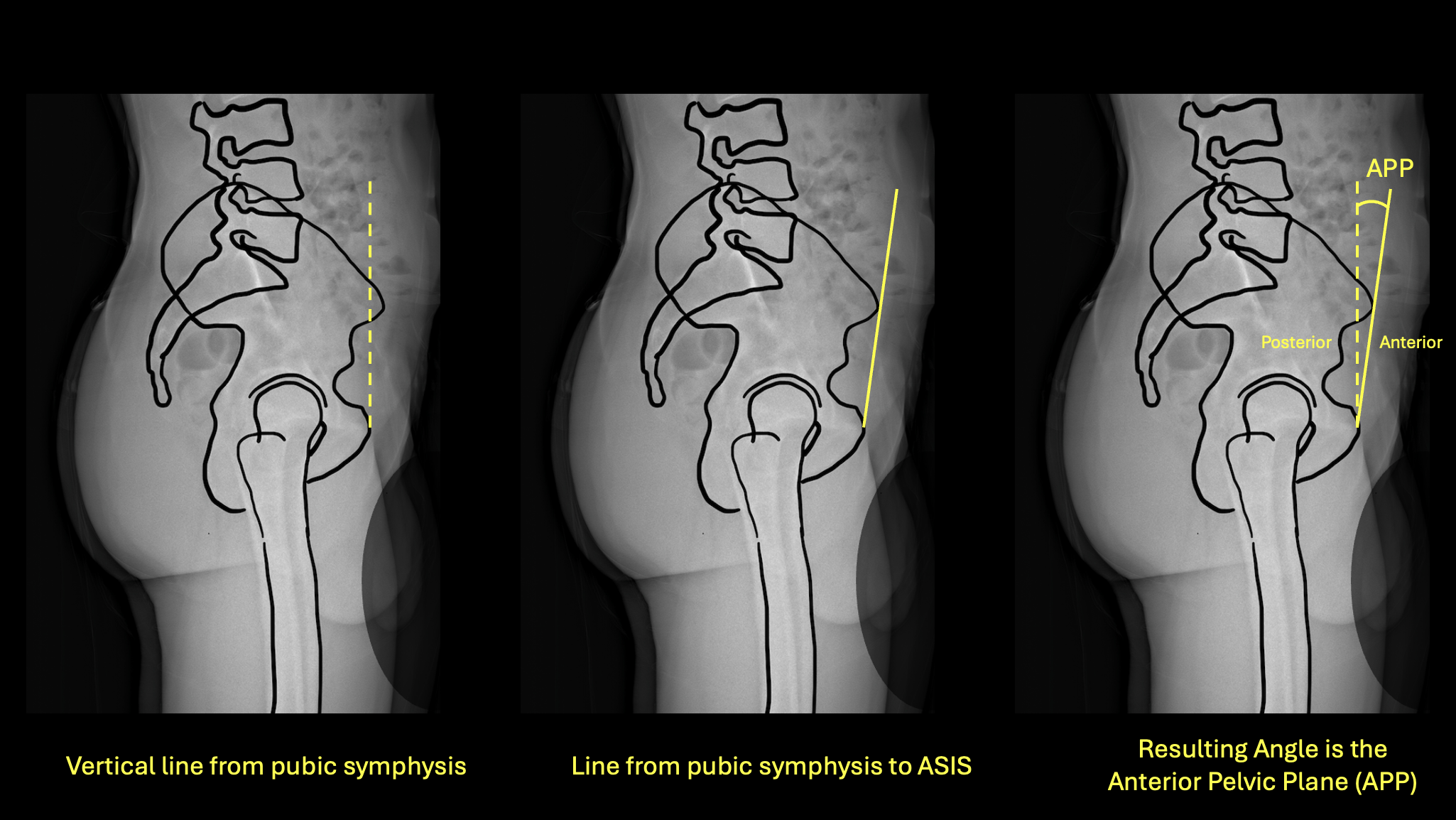 Anterior Pelvic Plane measurement diagram