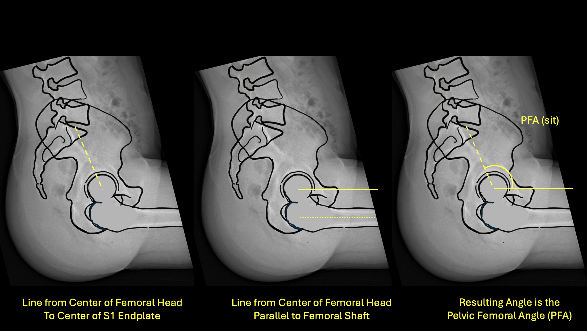 Proximal Femoral Angle sitting measurement diagram
