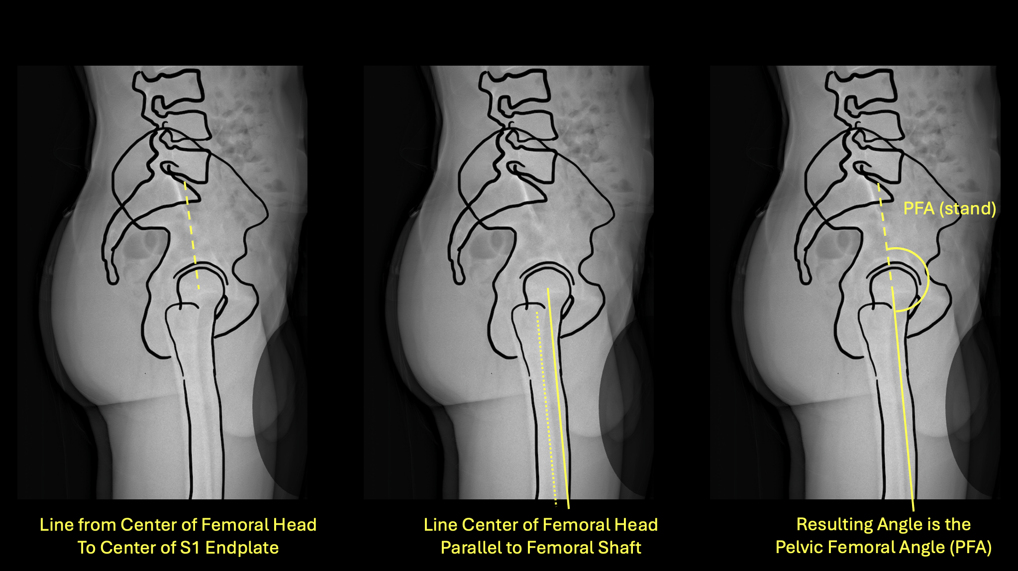 Proximal Femoral Angle standing measurement diagram