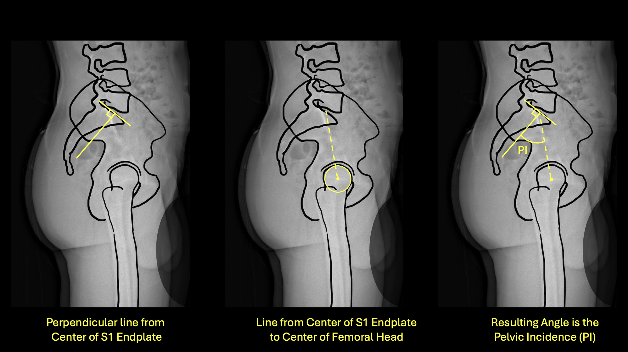 Pelvic Incidence measurement diagram