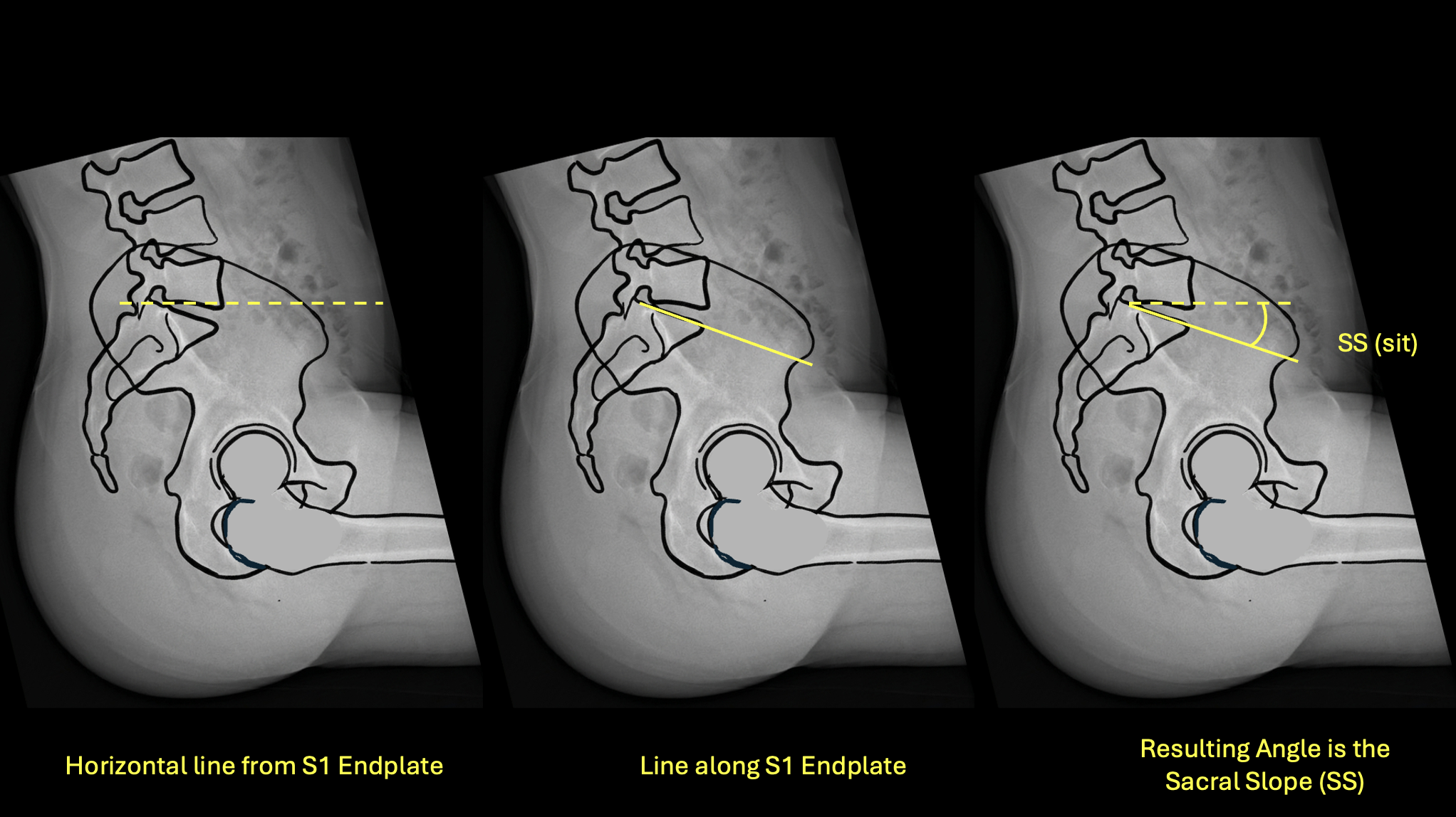Sacral Slope sitting measurement diagram
