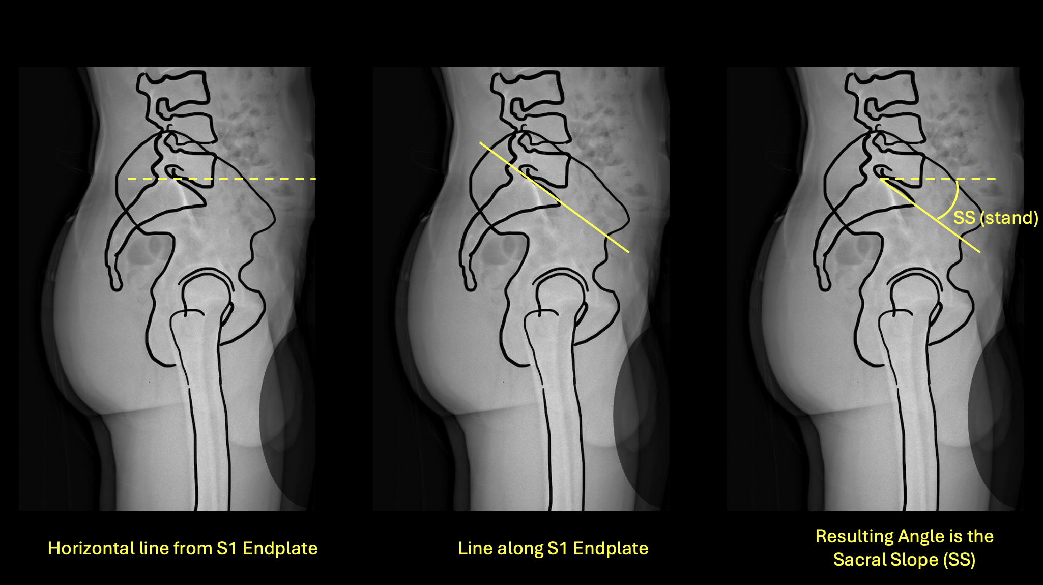 Sacral Slope standing measurement diagram